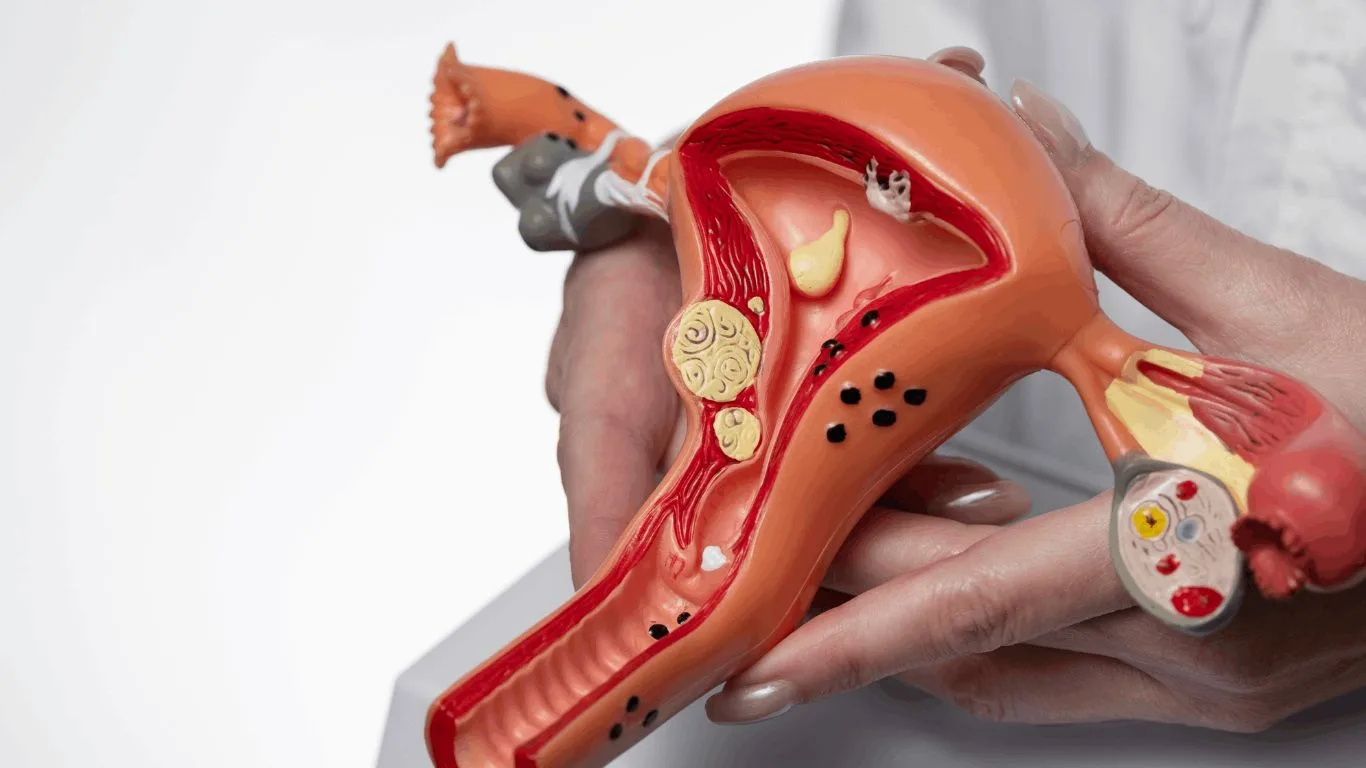 Endometriosis Causas, Síntomas y Tratamientos Disponibles